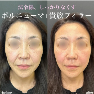 ルラ美容クリニック ボルニューマ症例