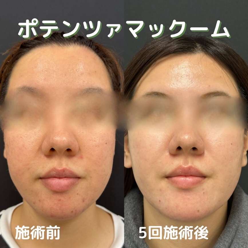 ルラ美容クリニック ポテンツァ症例画像