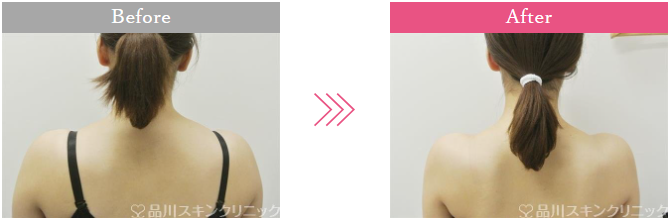 品川美容外科 肩ボトックス症例
