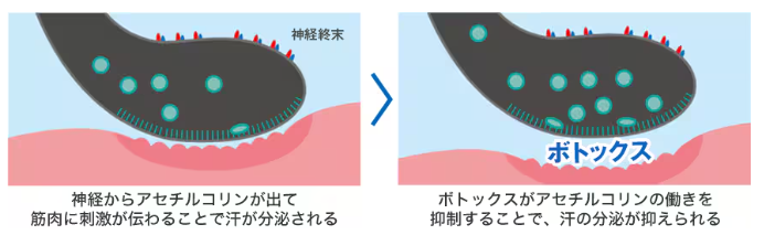 湘南美容クリニック 脇ボトックス