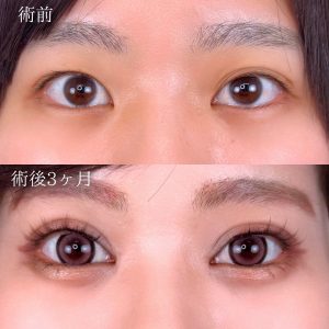 TCB東京中央美容外科 二重整形