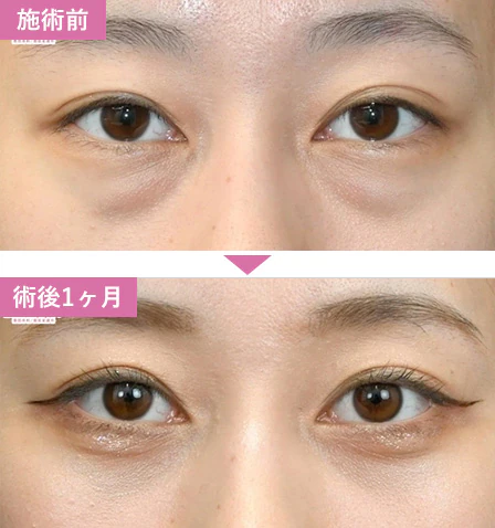 湘南美容クリニック　目の下のクマ取り・たるみ取り