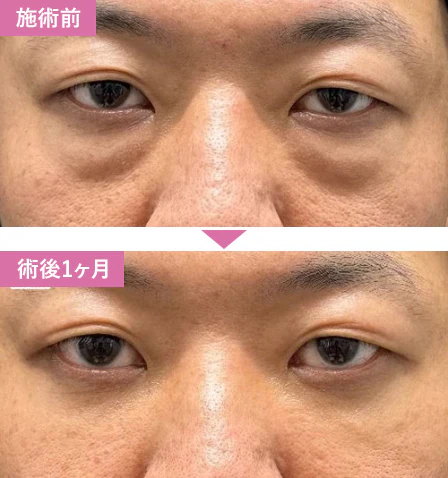 湘南美容クリニック　目の下のクマ取り