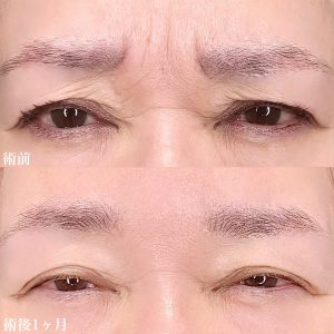 TCB東京中央美容外科　眉間ボトックス