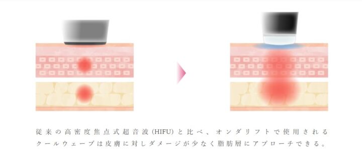 オンダリフト ハイフとの違い