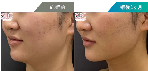 湘南美容クリニック　オンダリフト症例