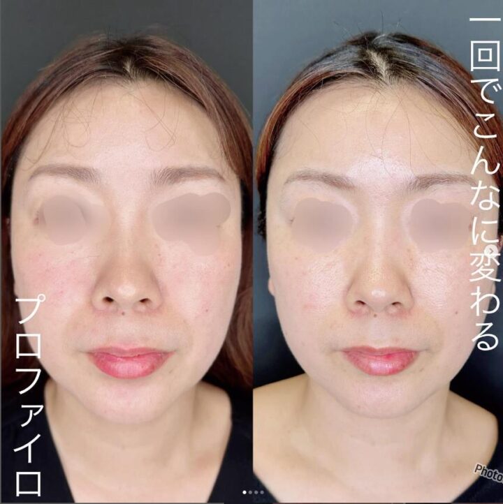 ルラ美容クリニック プロファイロ 症例画像