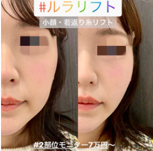 ルラ美容クリニック ルナリフト症例