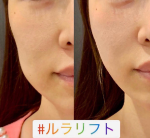 ルラ美容クリニック ルナリフト症例