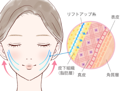 ルラ美容クリニック ルナリフト