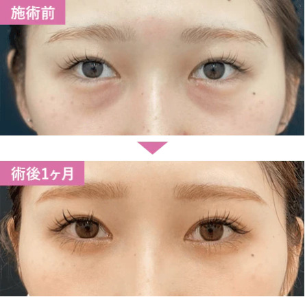 湘南美容クリニック　クマ取り症例画像