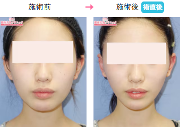 湘南美容クリニック プリマリフト症例画像