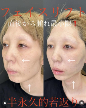 ルラ美容クリニック フェイスリフト症例