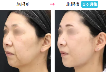 湘南美容クリニック プリマリフト症例画像