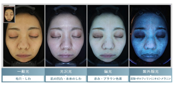 TCB東京中央美容外科 肌診断