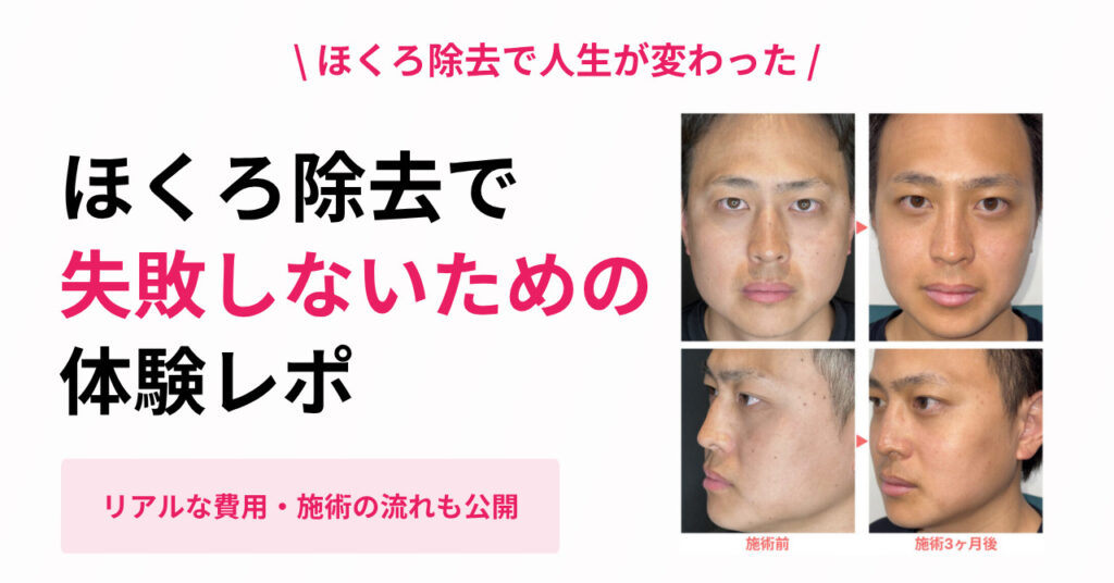 ほくろ除去で人生変わった 体験レポ アイキャッチ画像