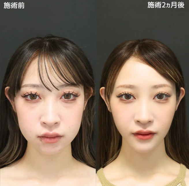 TAクリニック 糸リフト症例画像