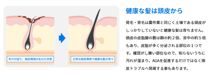 ゴリラクリニック_ハイドラスカルプ