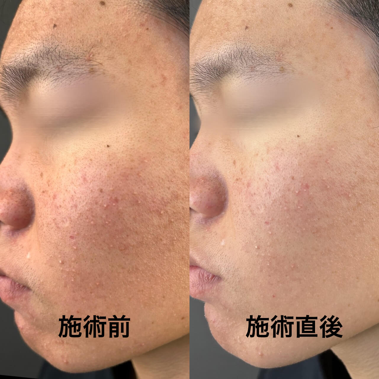 アドバテックスレーザー　my place beauty clinic