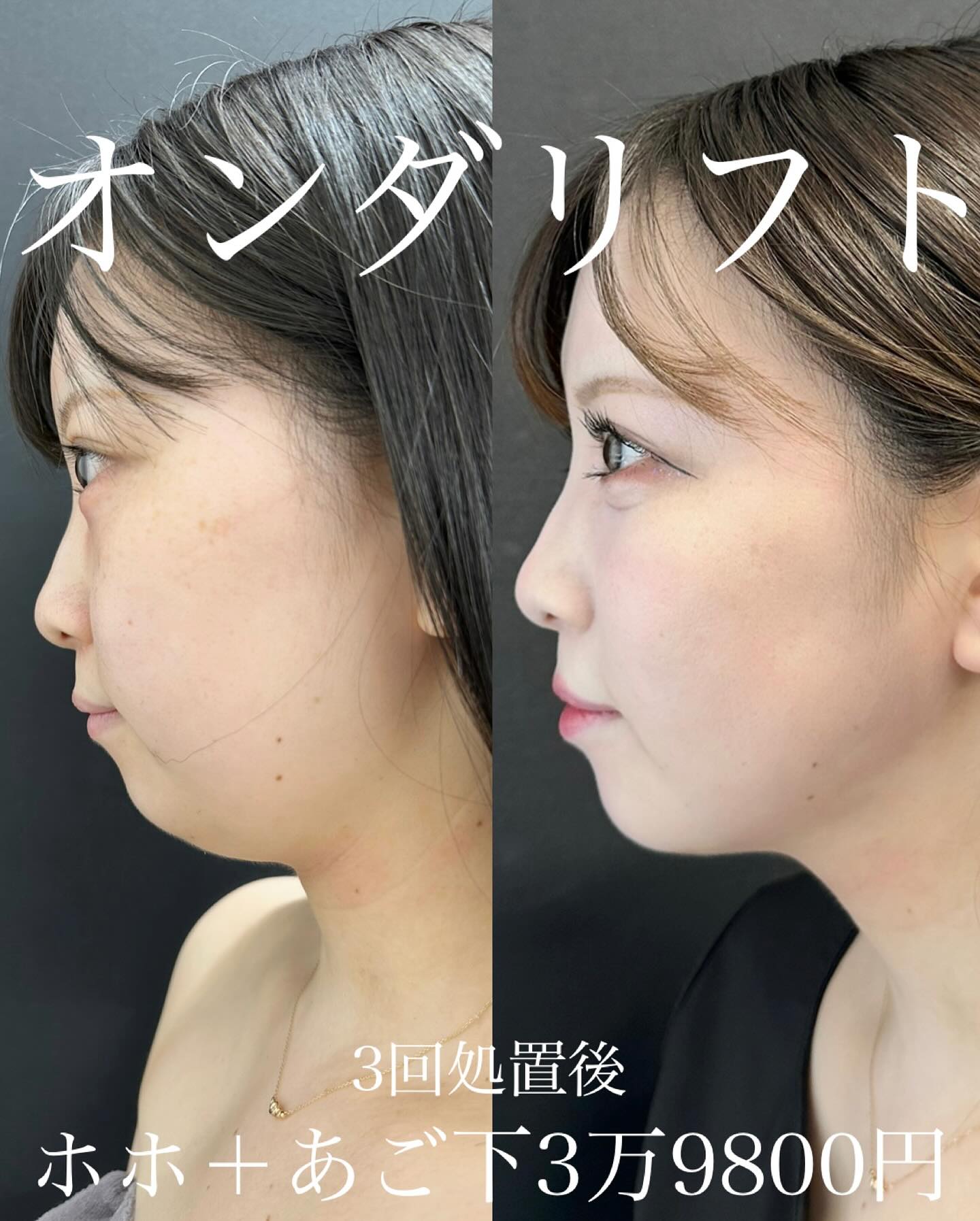 ルラ美容クリニック_オンダリフト_症例