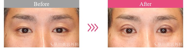 二重埋没　品川美容外科　症例
