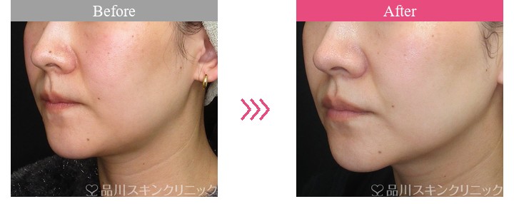 レーザートーニング　品川美容外科　症例