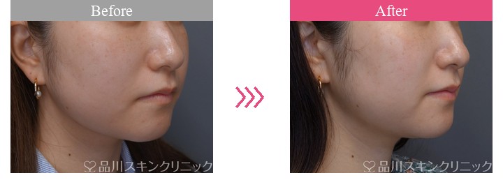 エラボトックス　品川美容外科　症例