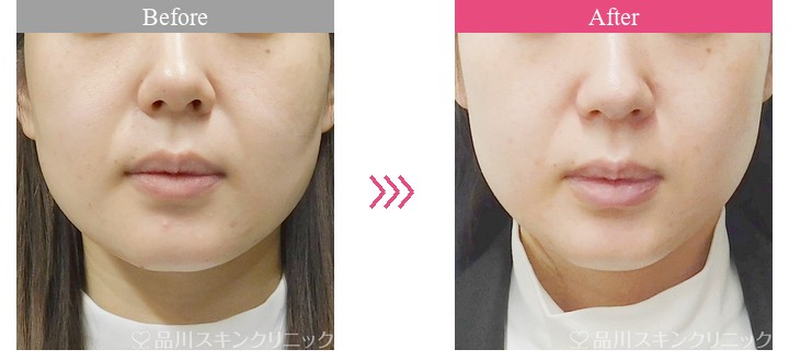 医療ハイフ　品川美容外科　症例
